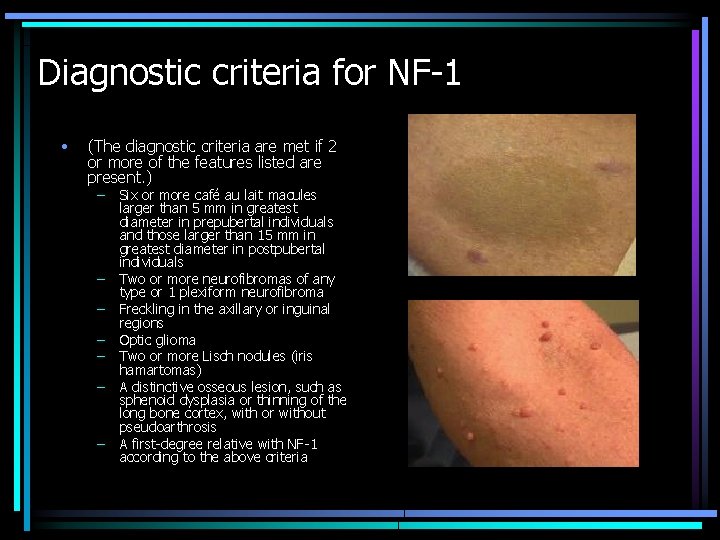 Diagnostic criteria for NF-1 • (The diagnostic criteria are met if 2 or more