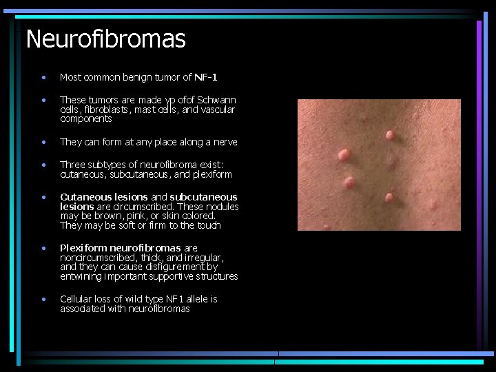 Neurofibromas • Most common benign tumor of NF-1 • These tumors are made yp