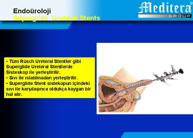 Endoüroloji Superglide Ureteral Stents • Tüm Rüsch Ureteral Stentler gibi Superglide Ureteral Stentlerde Sisteskop