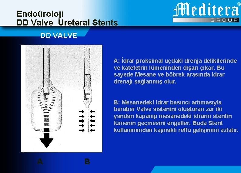 Endoüroloji DD Valve Ureteral Stents DD VALVE A: İdrar proksimal uçdaki drenja delikilerinde ve