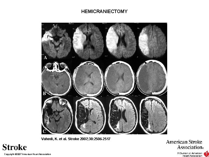HEMICRANIECTOMY Vahedi, K. et al. Stroke 2007; 38: 2506 -2517 Copyright © 2007 American