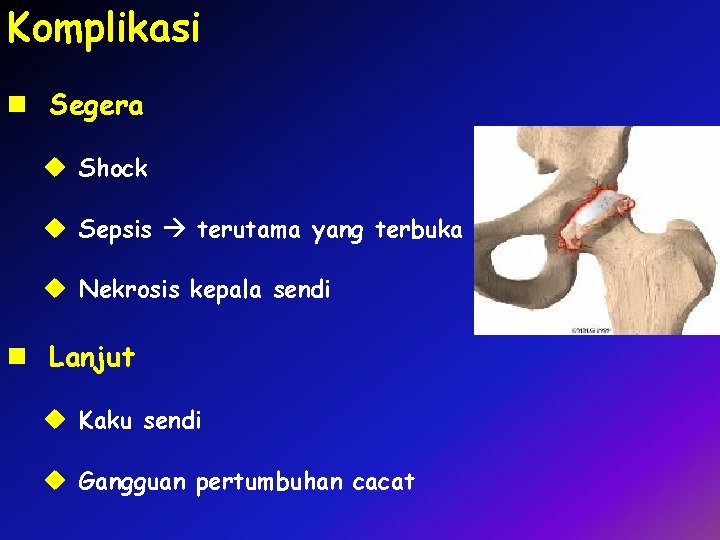 Komplikasi n Segera u Shock u Sepsis terutama yang terbuka u Nekrosis kepala sendi