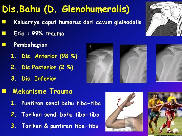 Dis. Bahu (D. Glenohumeralis) n Keluarnya caput humerus dari cavum gleinodalis n Etio :