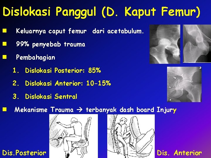 Dislokasi Panggul (D. Kaput Femur) n Keluarnya caput femur dari acetabulum. n 99% penyebab
