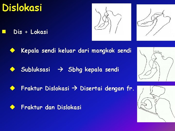 Dislokasi n Dis + Lokasi u Kepala sendi keluar dari mangkok sendi u Subluksasi