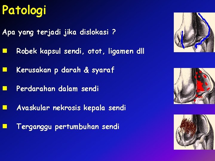 Patologi Apa yang terjadi jika dislokasi ? n Robek kapsul sendi, otot, ligamen dll