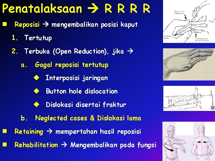 Penatalaksaan R R n Reposisi mengembalikan posisi kaput 1. Tertutup 2. Terbuka (Open Reduction),