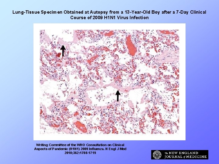 Lung-Tissue Specimen Obtained at Autopsy from a 13 -Year-Old Boy after a 7 -Day