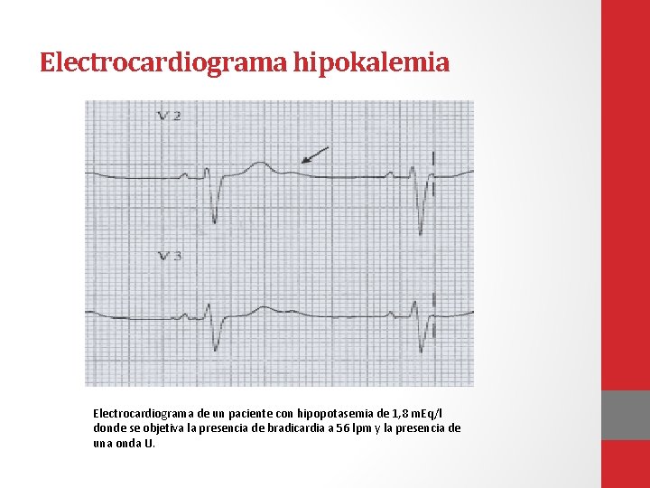 Electrocardiograma hipokalemia Electrocardiograma de un paciente con hipopotasemia de 1, 8 m. Eq/l donde