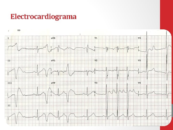 Electrocardiograma 