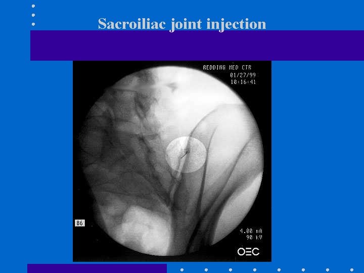 Sacroiliac joint injection 