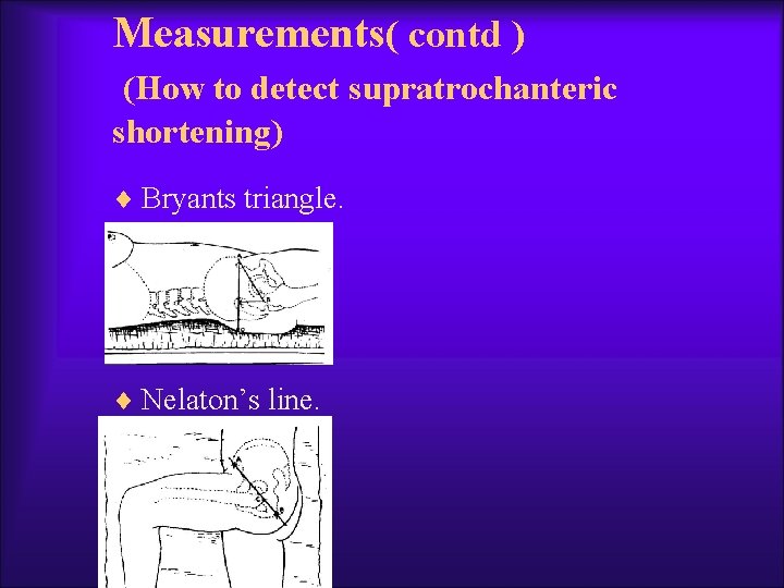 Measurements( contd ) (How to detect supratrochanteric shortening) ¨ Bryants triangle. ¨ Nelaton’s line.