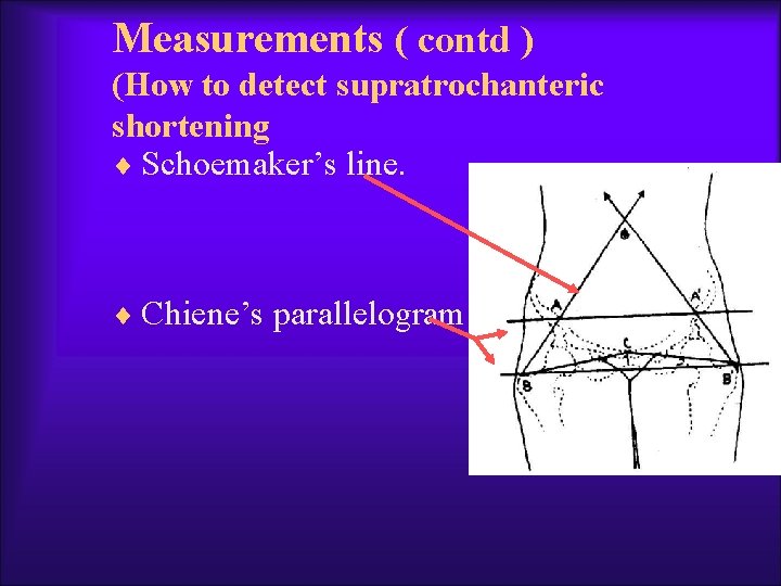 Measurements ( contd ) (How to detect supratrochanteric shortening ¨ Schoemaker’s line. ¨ Chiene’s