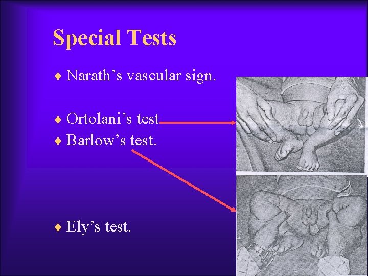 Special Tests ¨ Narath’s vascular sign. ¨ Ortolani’s test. ¨ Barlow’s test. ¨ Ely’s