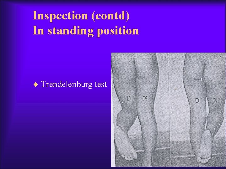 Inspection (contd) In standing position ¨ Trendelenburg test 