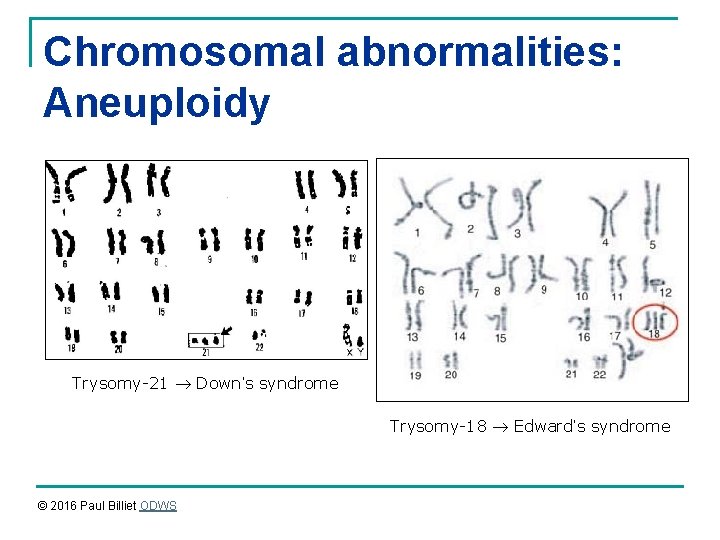 Chromosomal abnormalities: Aneuploidy Trysomy-21 Down’s syndrome Trysomy-18 Edward’s syndrome © 2016 Paul Billiet ODWS