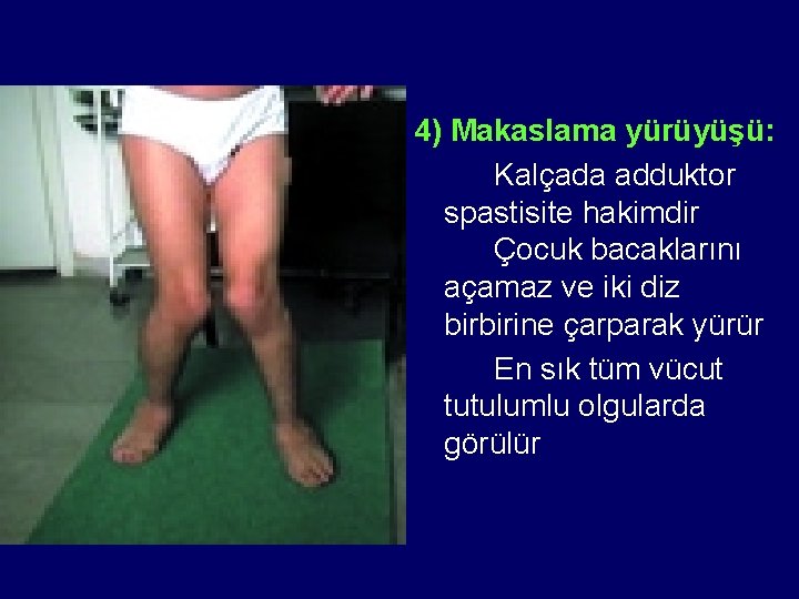 4) Makaslama yürüyüşü: Kalçada adduktor spastisite hakimdir Çocuk bacaklarını açamaz ve iki diz birbirine