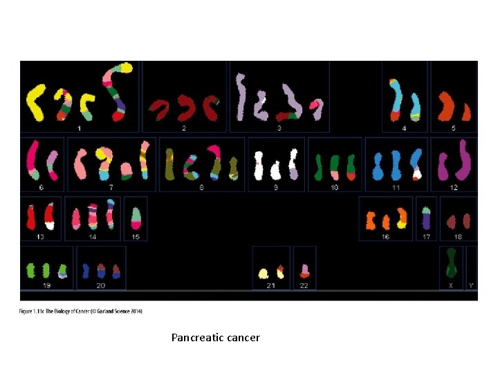 Pancreatic cancer 