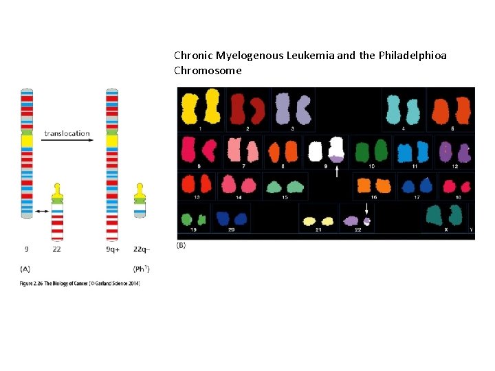 Chronic Myelogenous Leukemia and the Philadelphioa Chromosome 