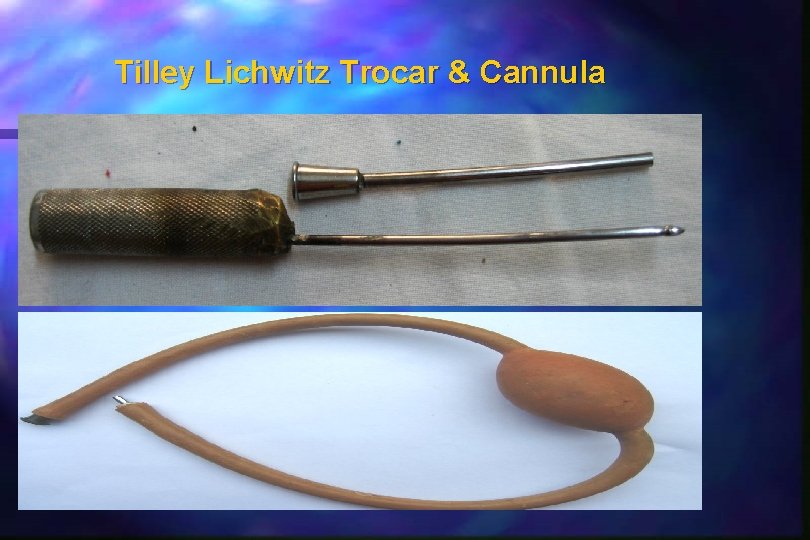 Tilley Lichwitz Trocar & Cannula Tilley Lichwitz Trocar & Cannula