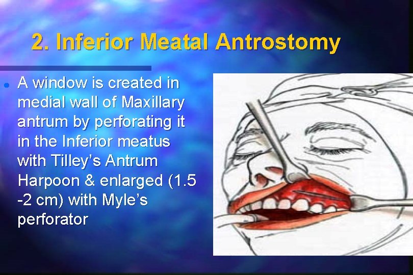 2. Inferior Meatal Antrostomy A window is created in medial wall of Maxillary antrum 2. Inferior Meatal Antrostomy A window is created in medial wall of Maxillary antrum