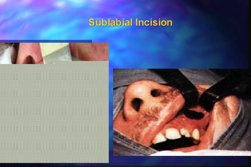 Sublabial Incision Sublabial Incision