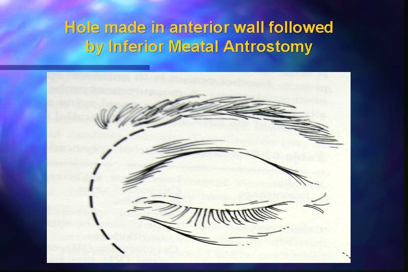 Hole made in anterior wall followed by Inferior Meatal Antrostomy Hole made in anterior wall followed by Inferior Meatal Antrostomy
