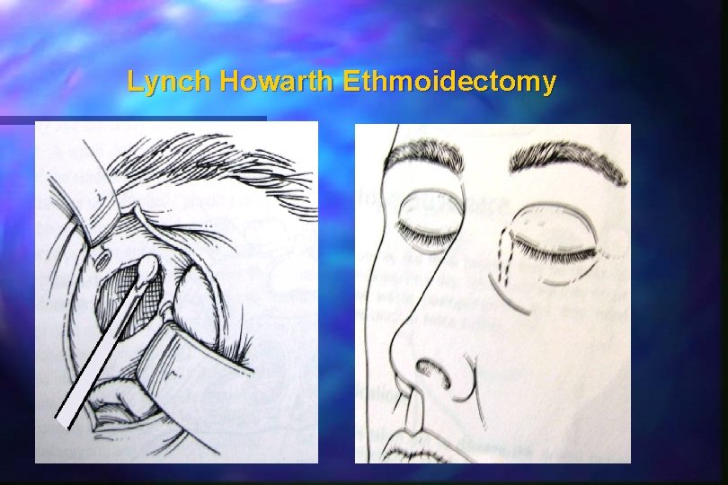 Lynch Howarth Ethmoidectomy 