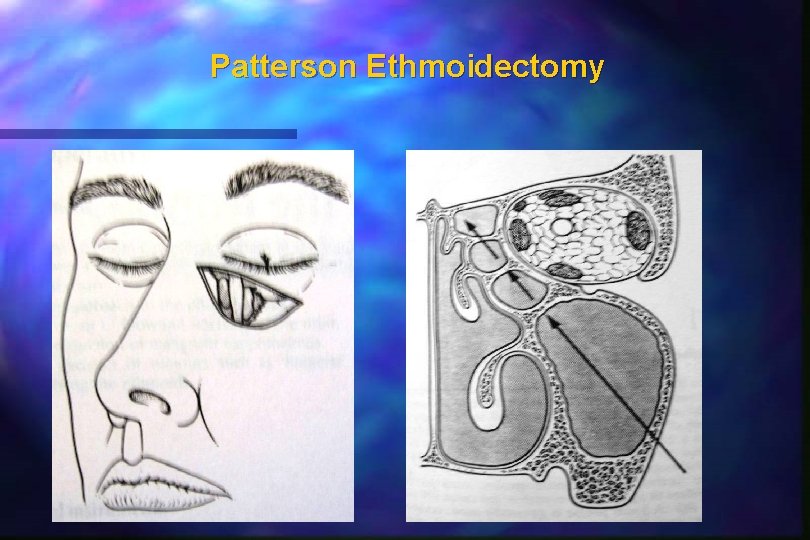 Patterson Ethmoidectomy 