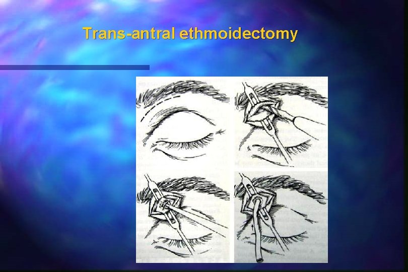 Trans-antral ethmoidectomy Trans-antral ethmoidectomy