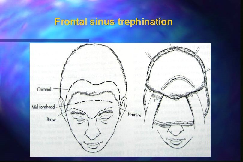 Frontal sinus trephination 