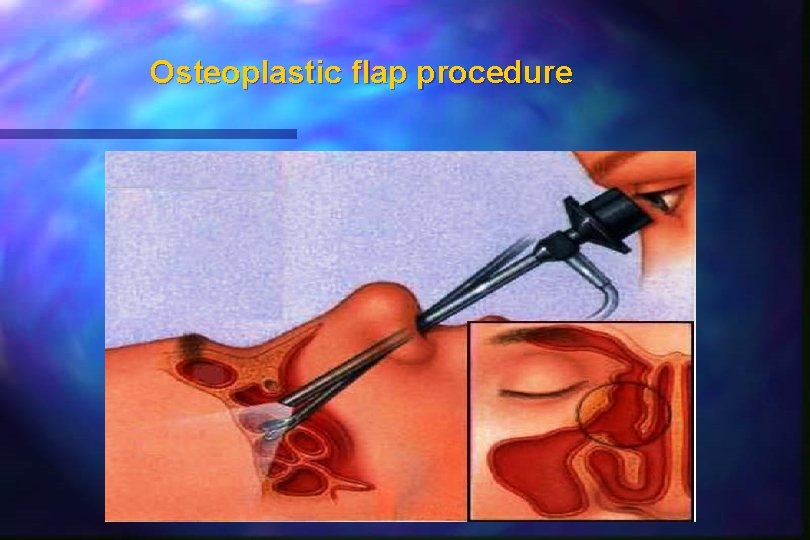 Osteoplastic flap procedure 