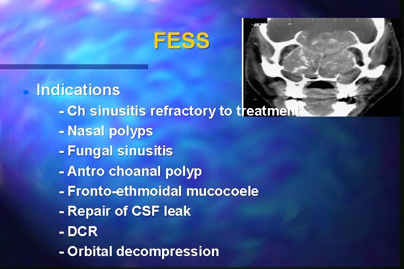 FESS Indications - Ch sinusitis refractory to treatment - Nasal polyps - Fungal sinusitis FESS Indications - Ch sinusitis refractory to treatment - Nasal polyps - Fungal sinusitis