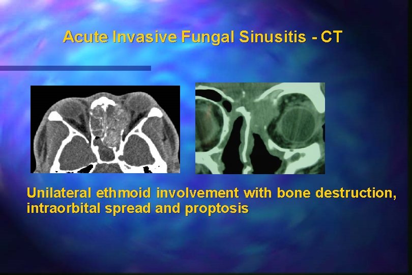 Acute Invasive Fungal Sinusitis - CT Unilateral ethmoid involvement with bone destruction, intraorbital spread Acute Invasive Fungal Sinusitis - CT Unilateral ethmoid involvement with bone destruction, intraorbital spread