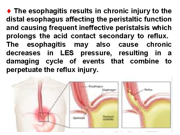  The esophagitis results in chronic injury to the distal esophagus affecting the peristaltic