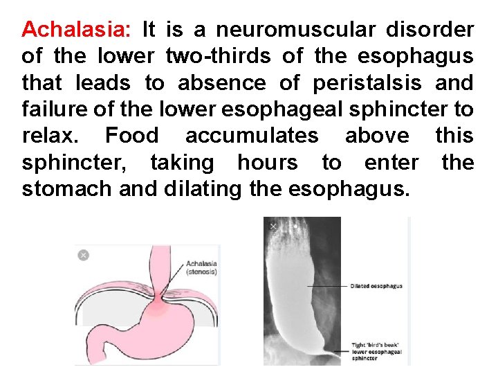 Achalasia: It is a neuromuscular disorder of the lower two-thirds of the esophagus that