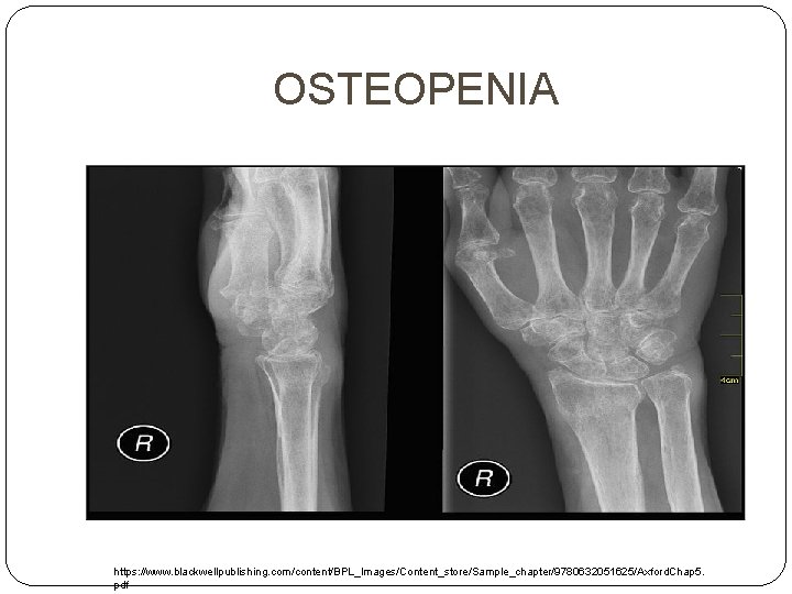 OSTEOPENIA https: //www. blackwellpublishing. com/content/BPL_Images/Content_store/Sample_chapter/9780632051625/Axford. Chap 5. pdf 