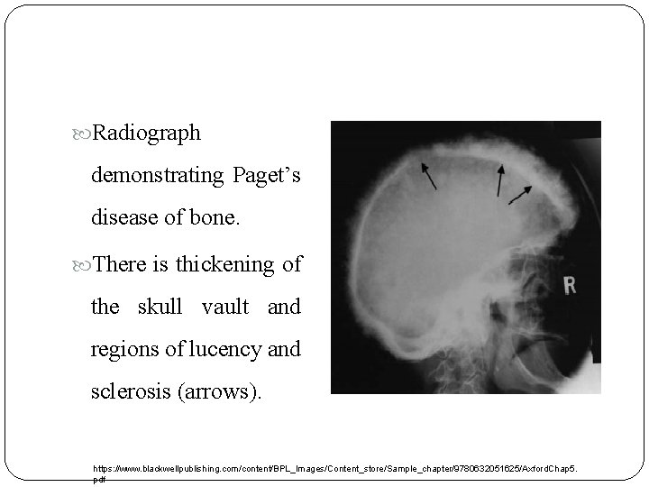  Radiograph demonstrating Paget’s disease of bone. There is thickening of the skull vault