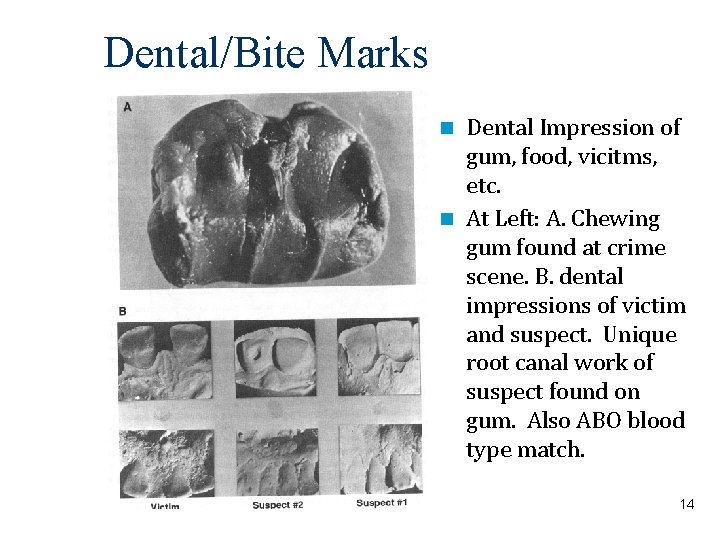Dental/Bite Marks Dental Impression of gum, food, vicitms, etc. At Left: A. Chewing gum
