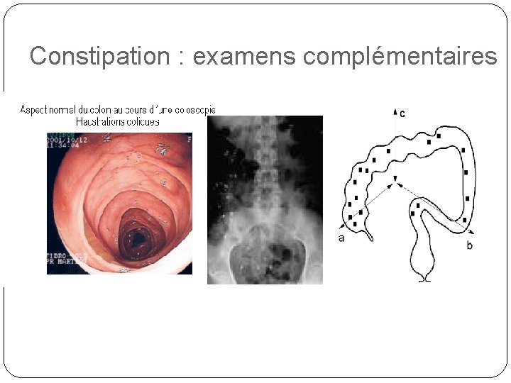 Constipation : examens complémentaires 