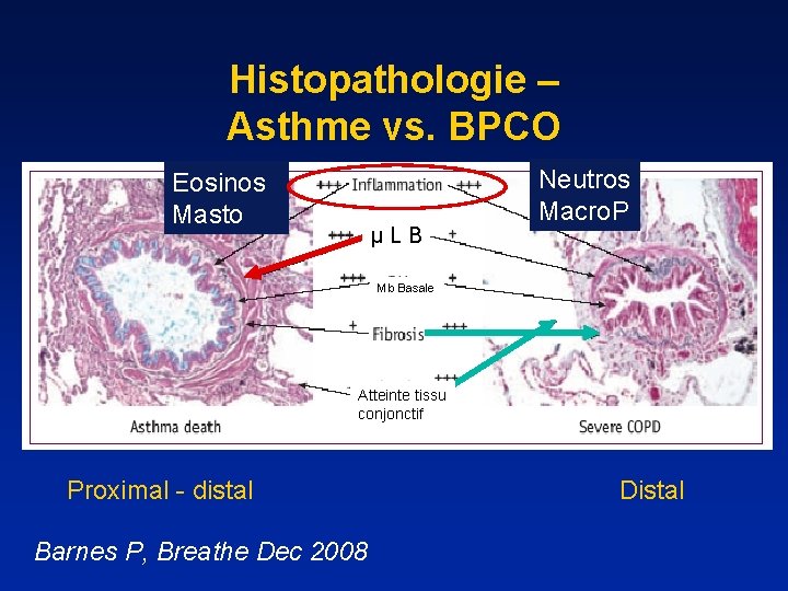 Histopathologie – Asthme vs. BPCO Eosinos Masto µ L B Neutros Macro. P Mb