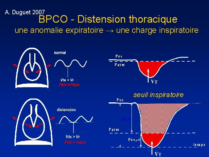 A. Duguet 2007 BPCO - Distension thoracique une anomalie expiratoire → une charge inspiratoire