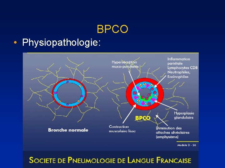 BPCO • Physiopathologie: 