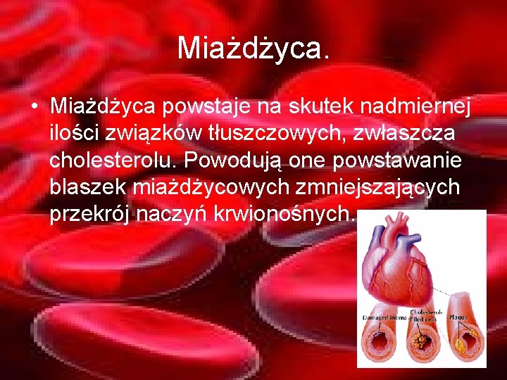 Miażdżyca. • Miażdżyca powstaje na skutek nadmiernej ilości związków tłuszczowych, zwłaszcza cholesterolu. Powodują one