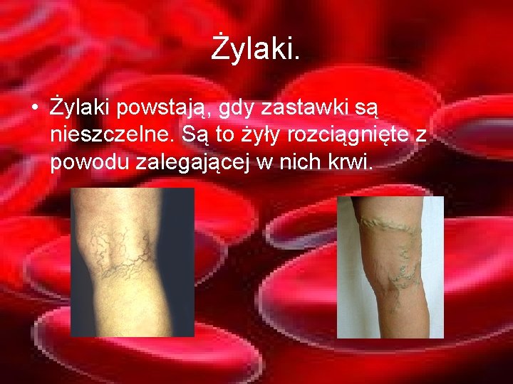 Żylaki. • Żylaki powstają, gdy zastawki są nieszczelne. Są to żyły rozciągnięte z powodu