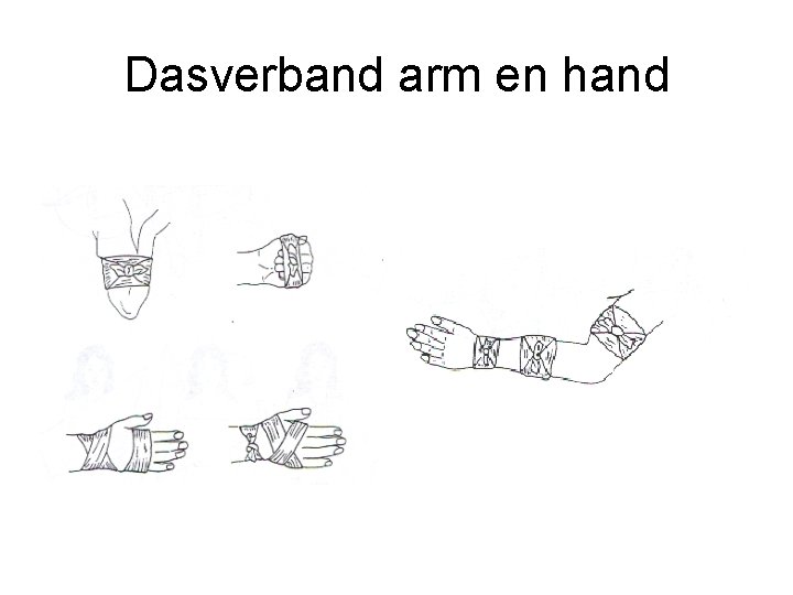 Dasverband arm en hand 