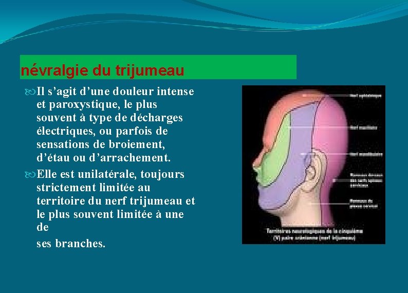 névralgie du trijumeau Il s’agit d’une douleur intense et paroxystique, le plus souvent à
