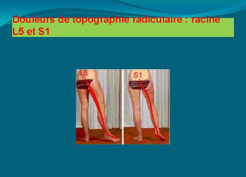 Douleurs de topographie radiculaire : racine L 5 et S 1 
