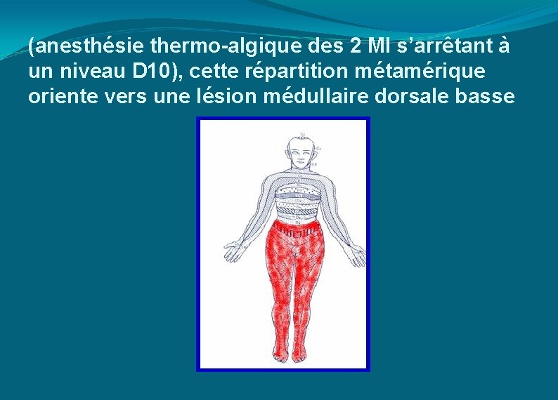 (anesthésie thermo-algique des 2 MI s’arrêtant à un niveau D 10), cette répartition métamérique