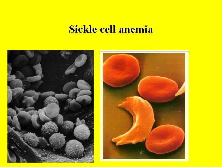 Sickle cell anemia 